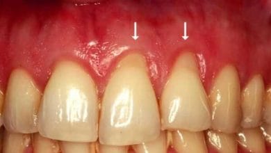 خونریزی لثه؛ دلایل پزشکی و روشهای درمان خانگی برای کاهش این مشکل 6 d8aed988d986d8b1db8cd8b2db8c d984d8abd987d89b d8afd984d8a7db8cd984 d9bed8b2d8b4daa9db8c d988 d8b1d988d8b4d987d8a7db8c d8afd8b1 67969b087da25