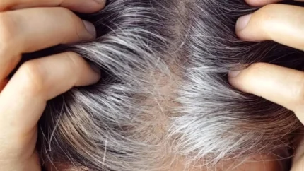 ریزش مو؛ زنگ خطر بدن برای یک بیماری جدی / چه علائمی همراه آن ظاهر میشود؟ / نکات حیاتی که همه باید بدانند 1 d8b1db8cd8b2d8b4 d985d988d89b d8b2d986daaf d8aed8b7d8b1 d8a8d8afd986 d8a8d8b1d8a7db8c db8cdaa9 d8a8db8cd985d8a7d8b1db8c d8acd8afdb8c 692b038b61c17